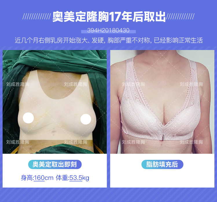 “揭秘奥美定取出后的真实颜色与健康隐患”